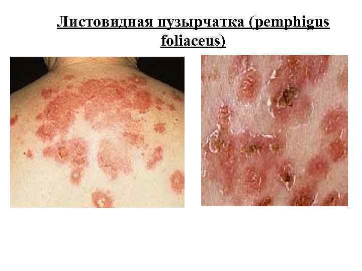 Листовидная пузырчатка (pemphigus foliaceus) 