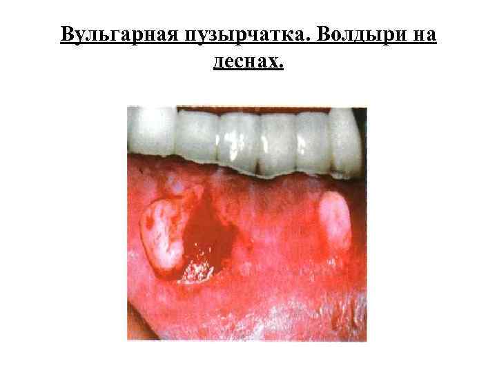 Вульгарная пузырчатка. Волдыри на деснах. 