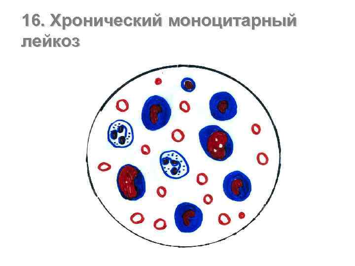 16. Хронический моноцитарный лейкоз 