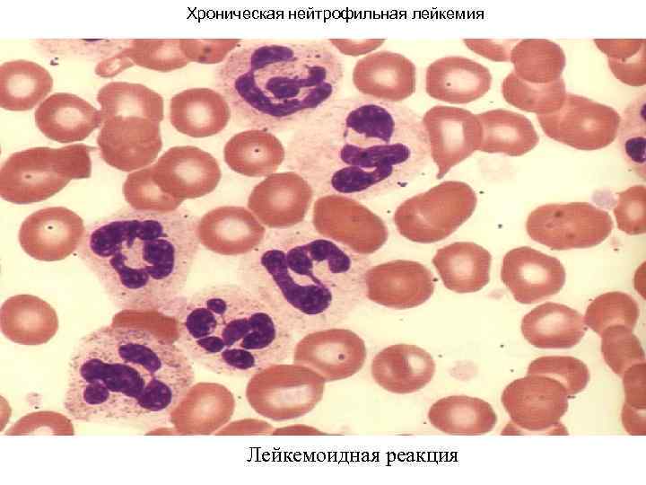 Хроническая нейтрофильная лейкемия Лейкемоидная реакция 