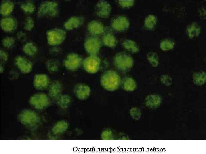 Острый лимфобластный лейкоз 