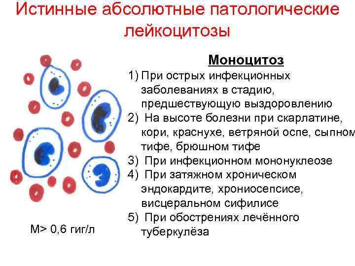 Истинные абсолютные патологические лейкоцитозы Моноцитоз М> 0, 6 гиг/л 1) При острых инфекционных заболеваниях