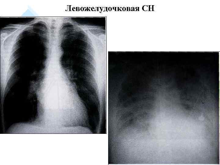 Левожелудочковая СН 