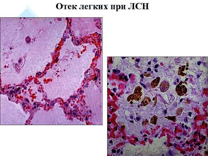 Отек легких при ЛСН 