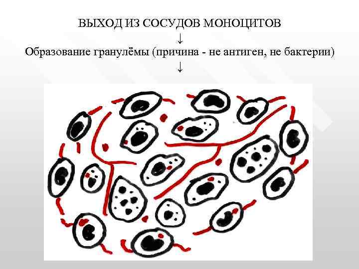 ВЫХОД ИЗ СОСУДОВ МОНОЦИТОВ ↓ Образование гранулёмы (причина - не антиген, не бактерии) ↓