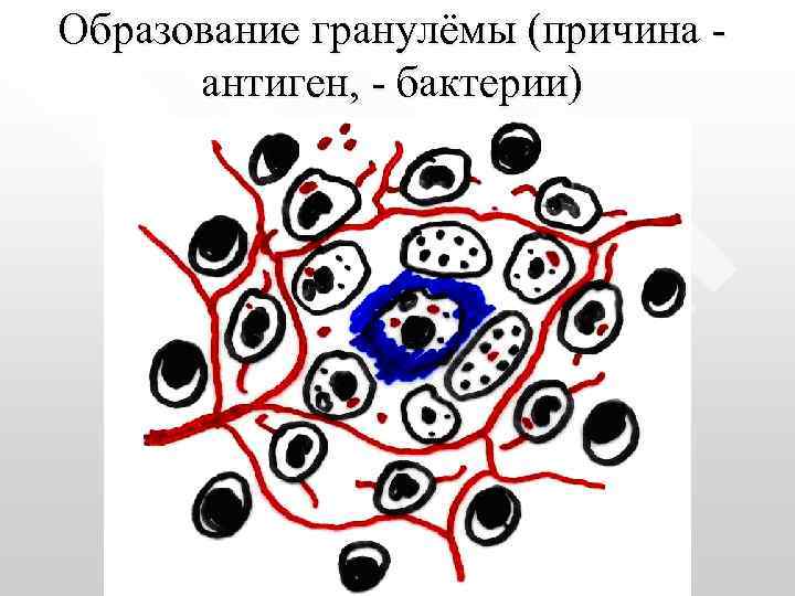 Образование гранулёмы (причина антиген, - бактерии) 