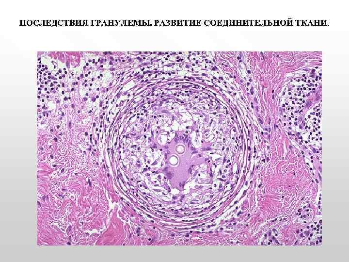 ПОСЛЕДСТВИЯ ГРАНУЛЕМЫ. РАЗВИТИЕ СОЕДИНИТЕЛЬНОЙ ТКАНИ. 