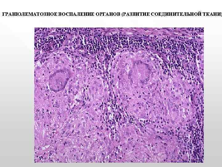 ГРАНЮЛЕМАТОЗНОЕ ВОСПАЛЕНИЕ ОРГАНОВ (РАЗВИТИЕ СОЕДИНИТЕЛЬНОЙ ТКАНИ) 