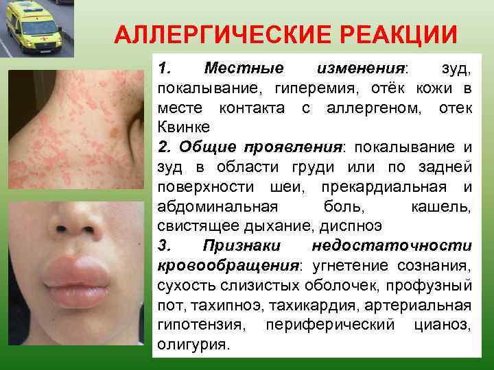 АЛЛЕРГИЧЕСКИЕ РЕАКЦИИ 1. Местные изменения: зуд, покалывание, гиперемия, отёк кожи в месте контакта с