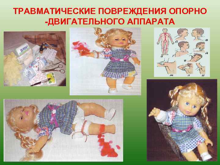 ТРАВМАТИЧЕСКИЕ ПОВРЕЖДЕНИЯ ОПОРНО -ДВИГАТЕЛЬНОГО АППАРАТА 