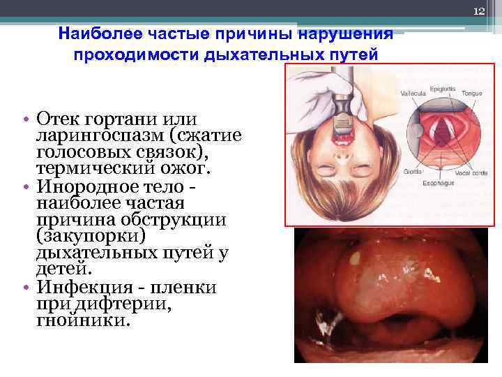 12 Наиболее частые причины нарушения проходимости дыхательных путей • Отек гортани или ларингоспазм (сжатие
