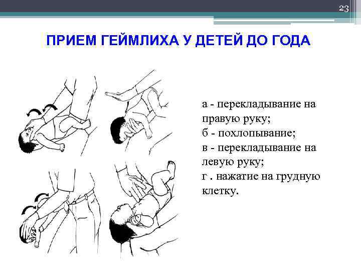 23 ПРИЕМ ГЕЙМЛИХА У ДЕТЕЙ ДО ГОДА а - перекладывание на правую руку; б