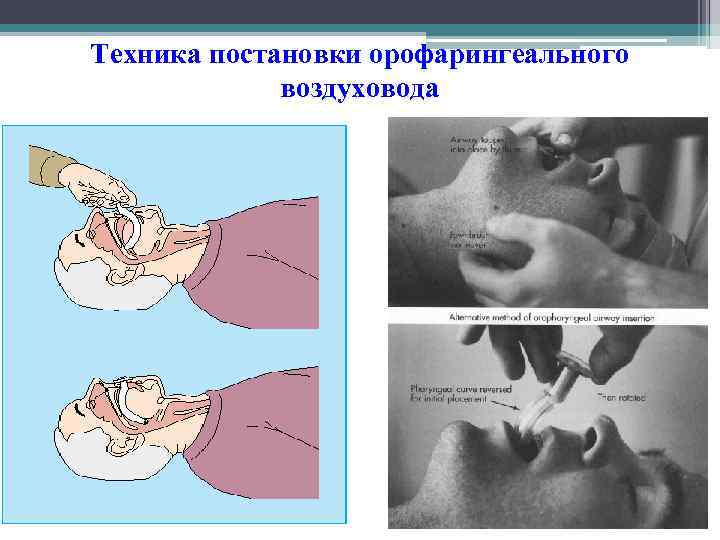 Техника постановки орофарингеального воздуховода 