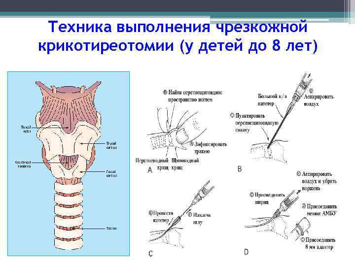 Техника выполнения чрезкожной крикотиреотомии (у детей до 8 лет) 