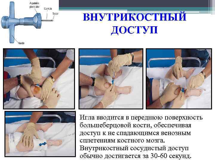 ВНУТРИКОСТНЫЙ ДОСТУП Игла вводится в переднюю поверхность большеберцовой кости, обеспечивая доступ к не спадающимся