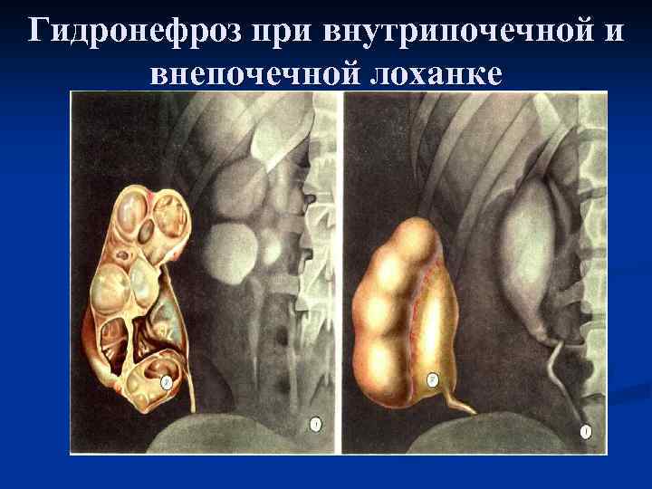 Гидронефроз при внутрипочечной и внепочечной лоханке 