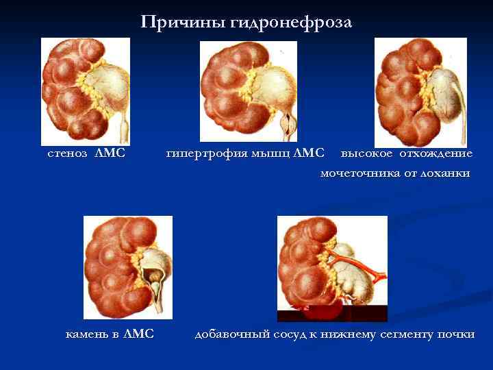 Причины гидронефроза стеноз ЛМС камень в ЛМС гипертрофия мышц ЛМС высокое отхождение мочеточника от