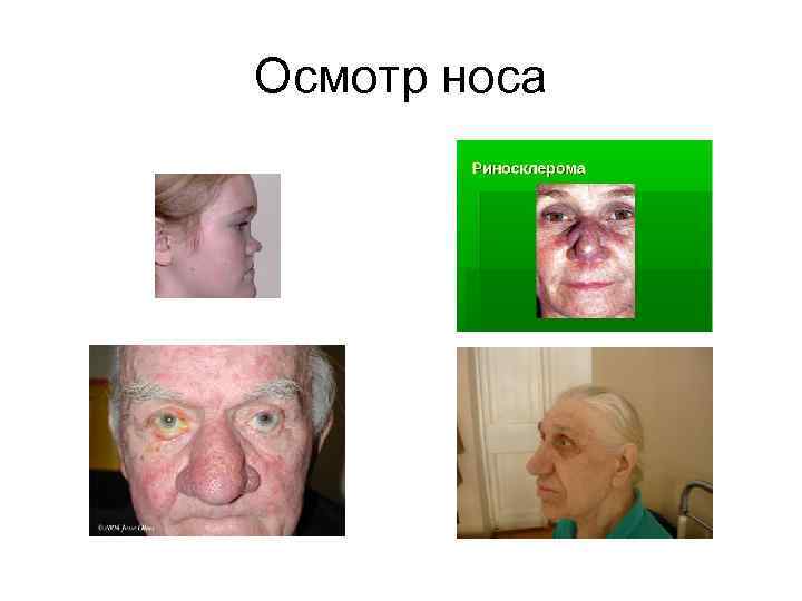 Осмотр носа 
