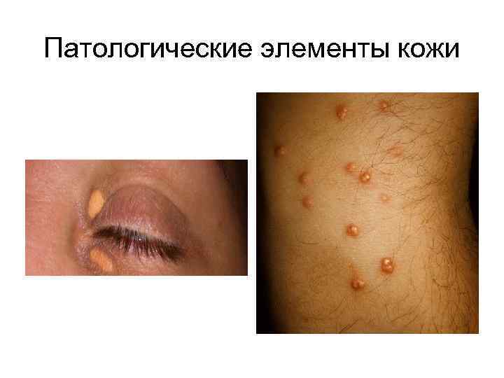 Патологические элементы кожи 