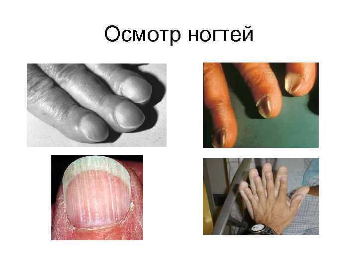 Осмотр ногтей 
