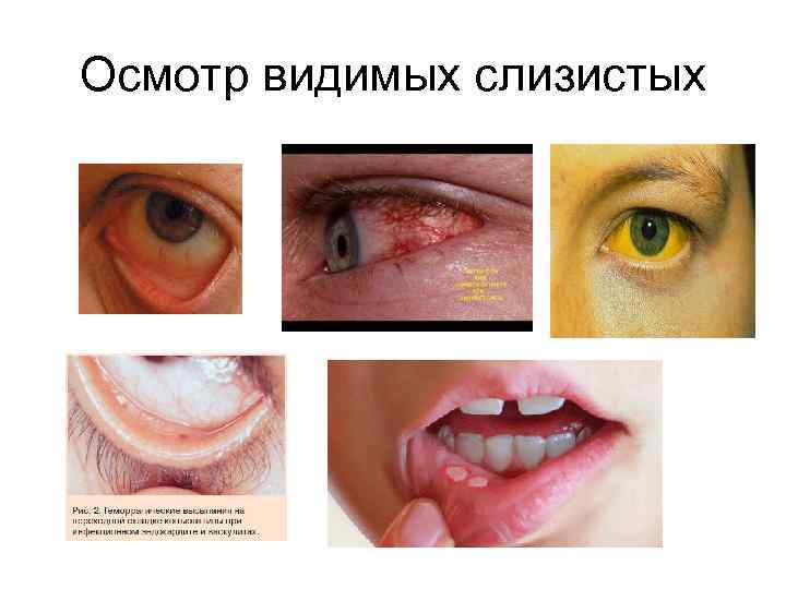 Осмотр видимых слизистых 