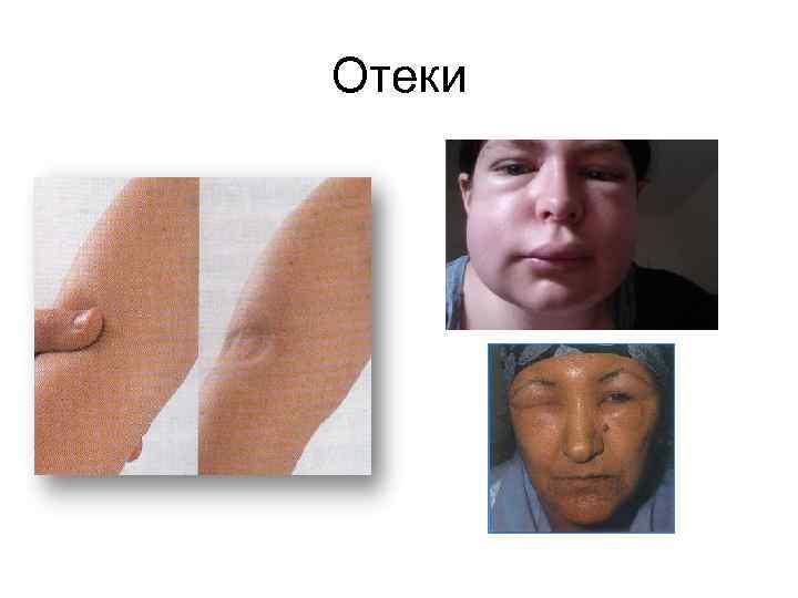 Отеки 