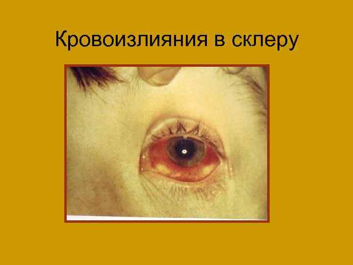 Кровоизлияния в склеру 