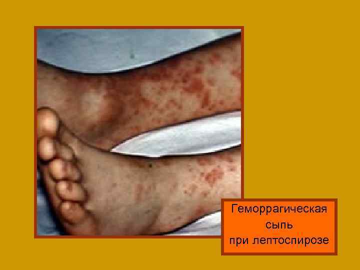 Геморрагическая сыпь при лептоспирозе 