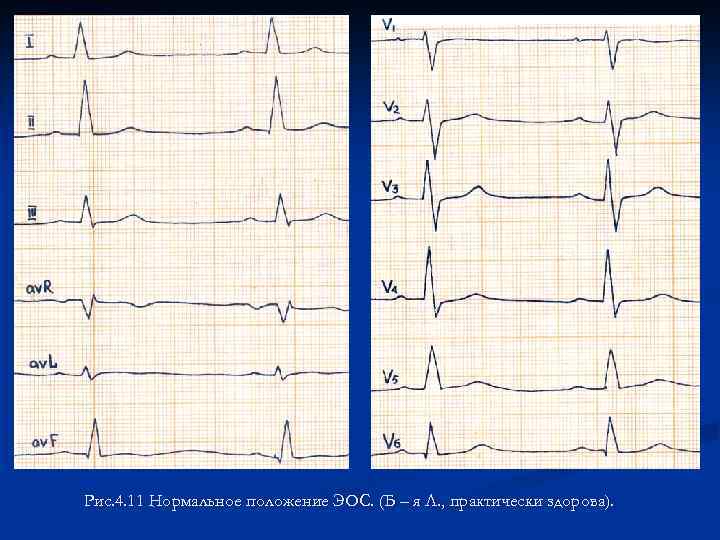 Рис. 4. 11 Нормальное положение ЭОС. (Б – я Л. , практически здорова). 