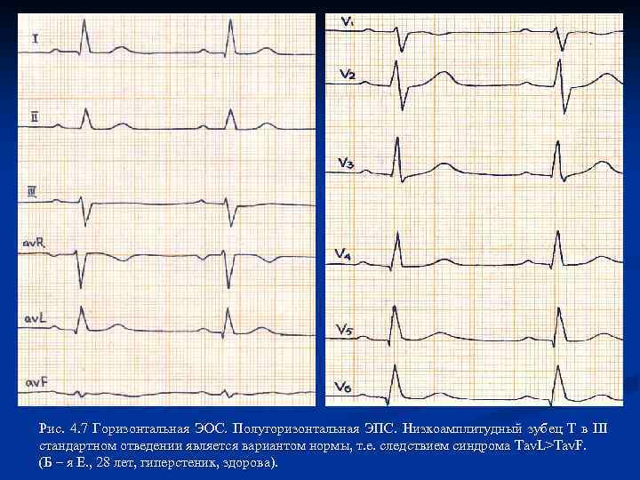 Рис. 4. 7 Горизонтальная ЭОС. Полугоризонтальная ЭПС. Низкоамплитудный зубец Т в III стандартном отведении