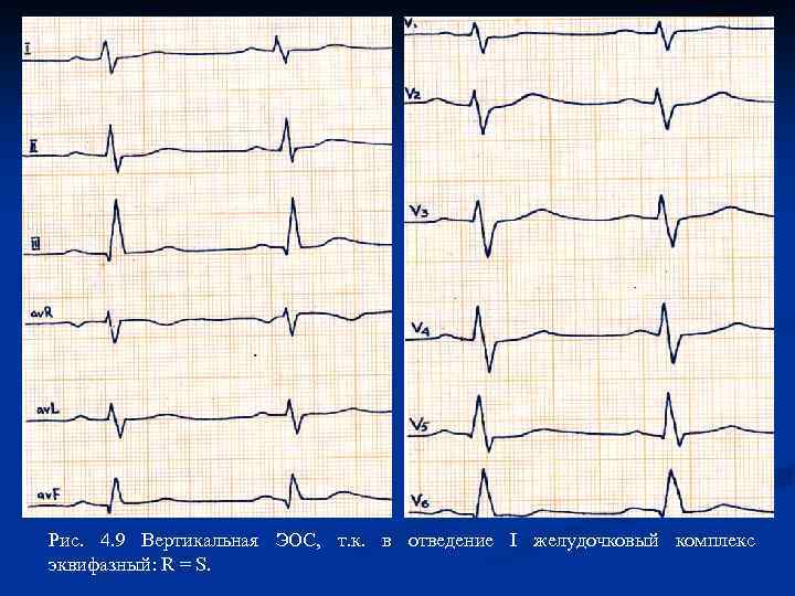 Вертикальный экг