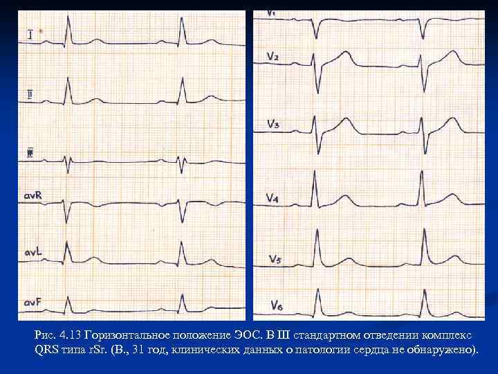 Рис. 4. 13 Горизонтальное положение ЭОС. В III стандартном отведении комплекс QRS типа r.