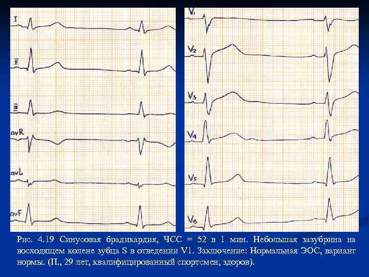 Рис. 4. 19 Синусовая брадикардия, ЧСС = 52 в 1 мин. Небольшая зазубрина на