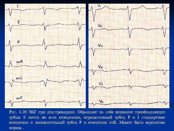Рис. 4. 20 ЭКГ при декстрокардии. Обращают на себя внимание преобладающие зубцы S почти