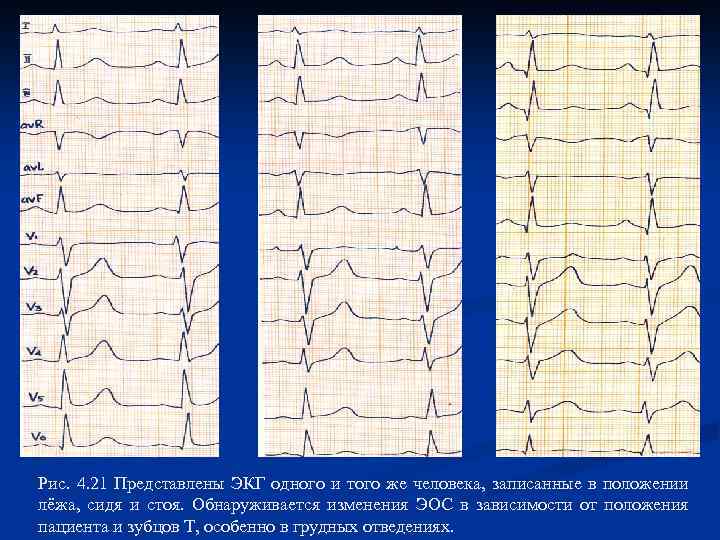 Рис. 4. 21 Представлены ЭКГ одного и того же человека, записанные в положении лёжа,