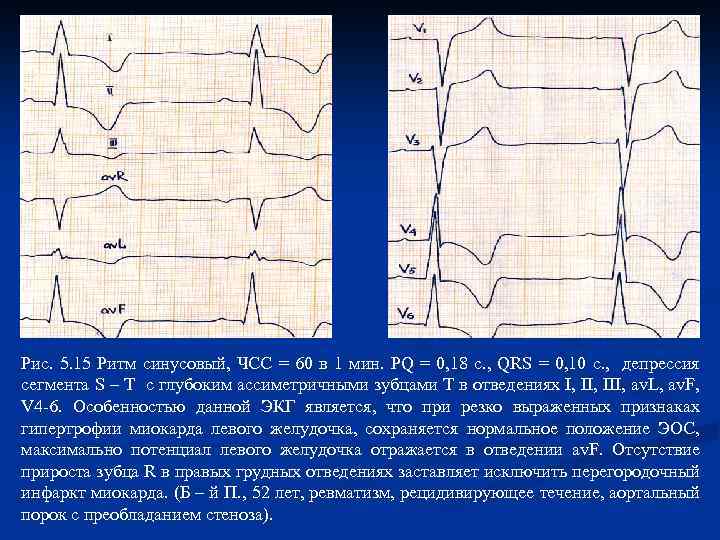 Рис. 5. 15 Ритм синусовый, ЧСС = 60 в 1 мин. PQ = 0,