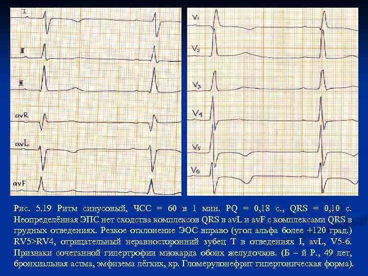 Рис. 5. 19 Ритм синусовый, ЧСС = 60 в 1 мин. PQ = 0,