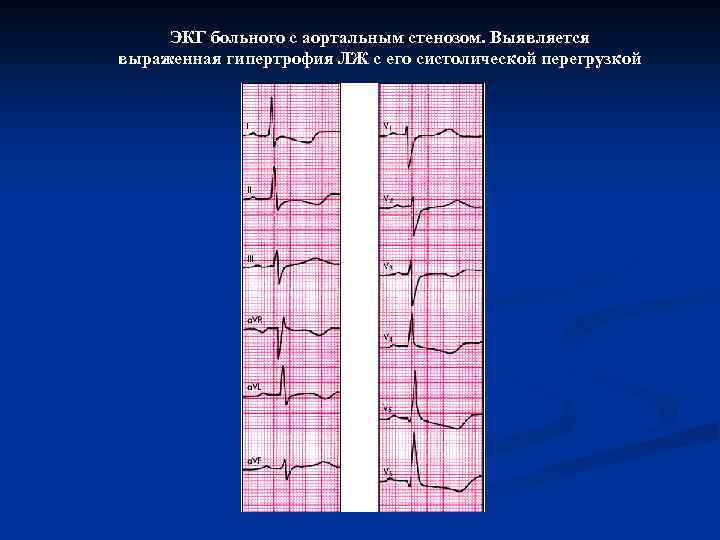 ЭКГ больного с аортальным стенозом. Выявляется выраженная гипертрофия ЛЖ с его систолической перегрузкой 
