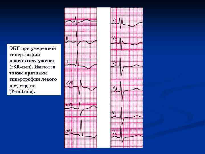 ЭКГ при умеренной гипертрофии правого желудочка (r. SR-тип). Имеются также признаки гипертрофии левого предсердия