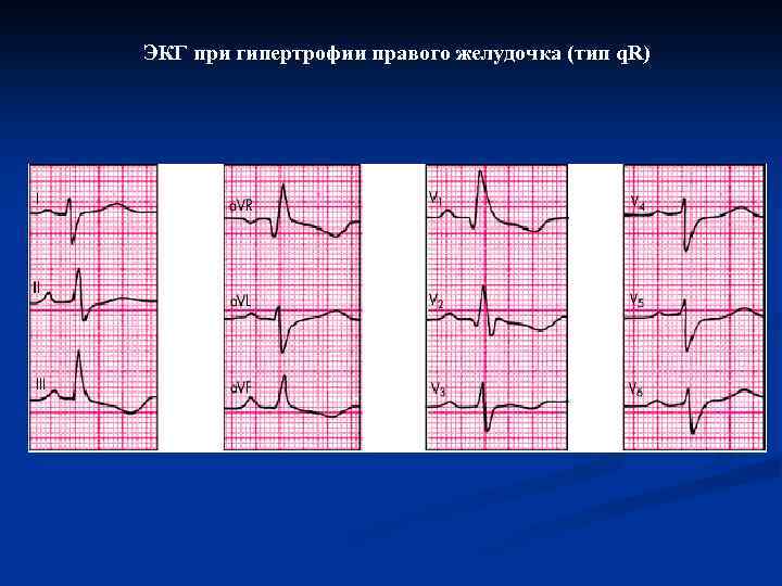 ЭКГ при гипертрофии правого желудочка (тип q. R) 