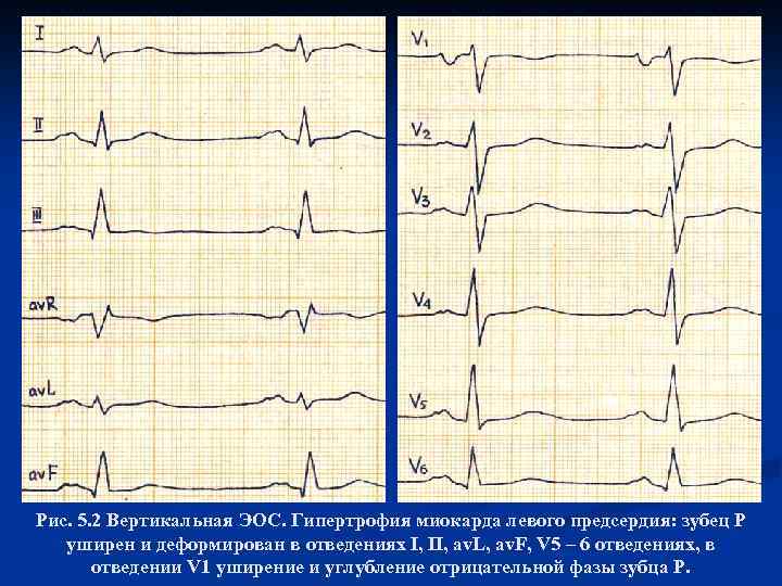 Рис. 5. 2 Вертикальная ЭОС. Гипертрофия миокарда левого предсердия: зубец Р уширен и деформирован