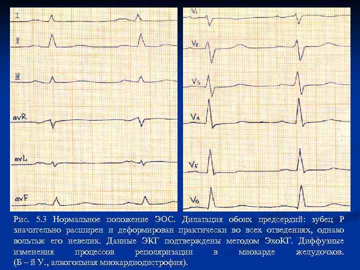 Рис. 5. 3 Нормальное положение ЭОС. Дилатация обоих предсердий: зубец Р значительно расширен и
