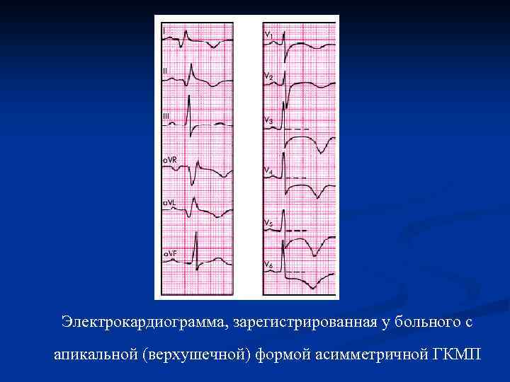 Электрокардиограмма, зарегистрированная у больного с апикальной (верхушечной) формой асимметричной ГКМП 