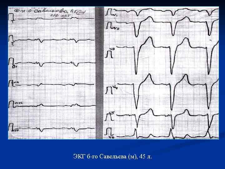 ЭКГ б-го Савельева (м), 45 л. 