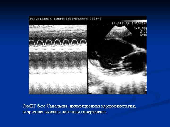 Эхо. КГ б-го Савельева: дилатационная кардиомиопатия, вторичная высокая легочная гипертензия. 