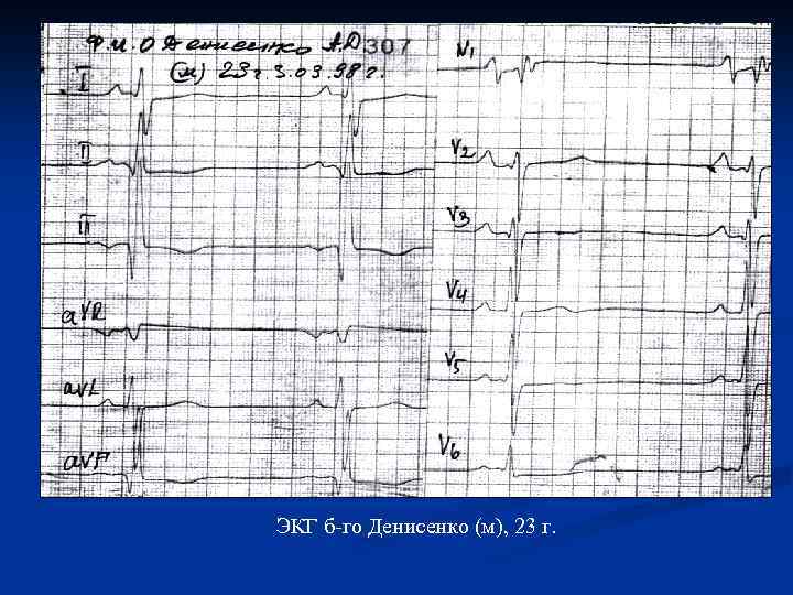 ЭКГ б-го Денисенко (м), 23 г. 