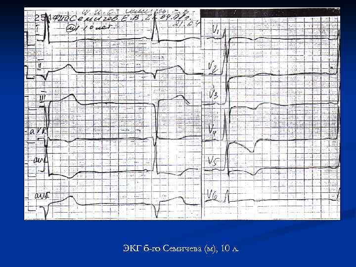 ЭКГ б-го Семичева (м), 10 л. 