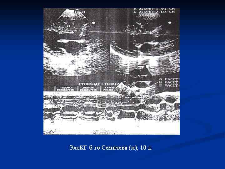 Эхо. КГ б-го Семичева (м), 10 л. 