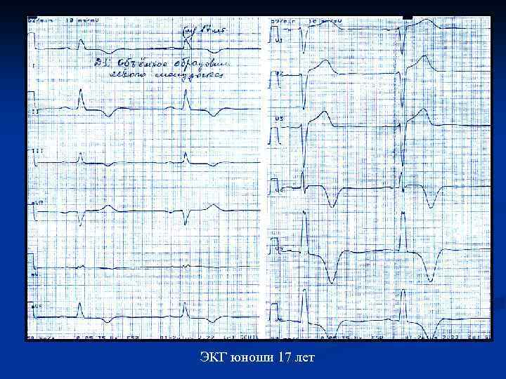 ЭКГ юноши 17 лет 