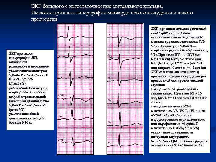 ЭКГ больного с недостаточностью митрального клапана. Имеются признаки гипертрофии миокарда левого желудочка и левого